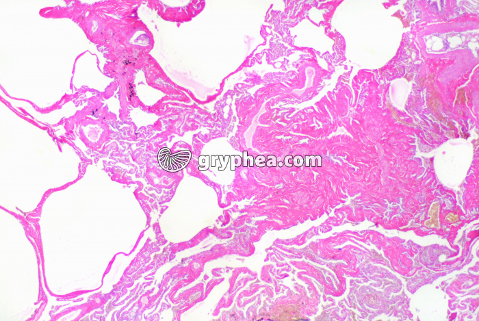 Emphysème pulmonaire x10 - gryphea.org